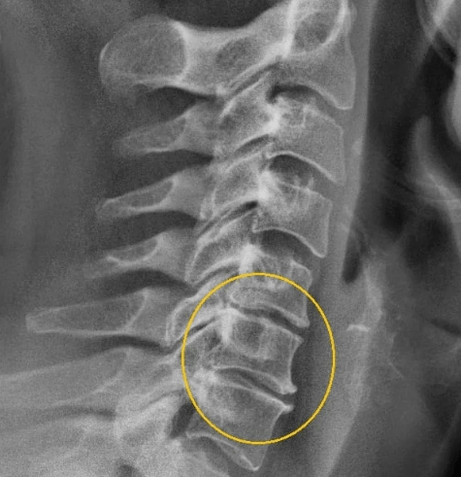 Zervikale Osteochondrose